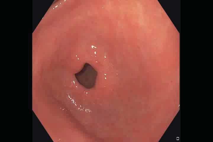 Endoscopy of GIM What is gastric intestinal metaplasia?