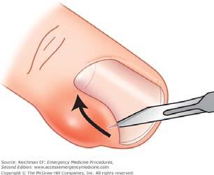 Scalpel blade parallel to the nail.