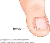 Onychocryptosis (Ingrown toenail) involves a spicule of the lateral nail plate piercing the lateral