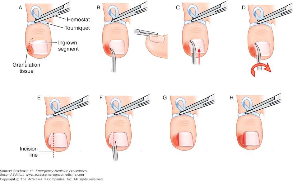 Onychocryptosis: Nail Wedge Resection Indication Recurrent ingrown toenail Complications