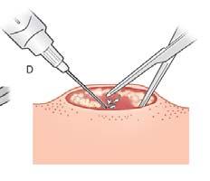 Incision Linear incision across the diameter of