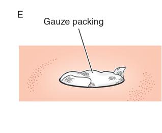 Procedure Steps 6. Packing Goal of preventing premature closure of large (>5cm) abscess cavities or complex cavities such as pilonidal. Of questionable usefulness.