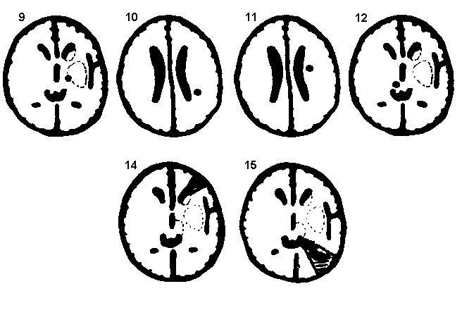 =Brainstem* CS =Cerebellum and brainstem * code sub-territory sites in b b) sub-territory sites MCA sub-territory codes 1=small cortical infarct 2=basal ganglia infarct (>2x2x2cm) 3=infarct of white