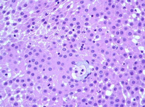 Oncocytic MEC Histology Predominant epithelioid oncocytic cells Focal