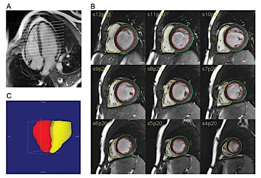 Cardiac MRI Assess function PR RF RVEDV(i),