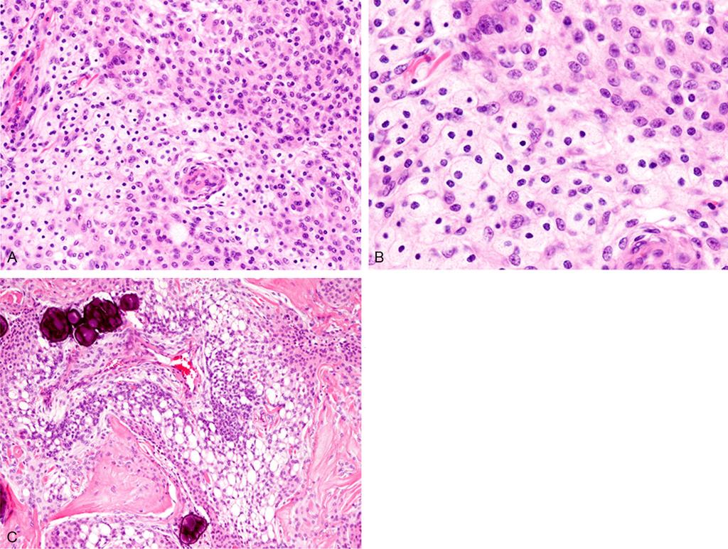Figure 2. Histopathological features. A: The tumor comprises two components.