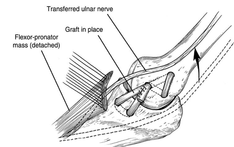 UCL Reconstruction Ulnar nerve