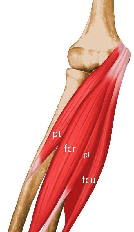Flexor Pronator Injury Medial Epicondylitis = Golfer s Elbow repetitive valgus forces = chronic inflammatory changes 10-20 X less common than lateral Pronator teres, FCR, FCU PT highest