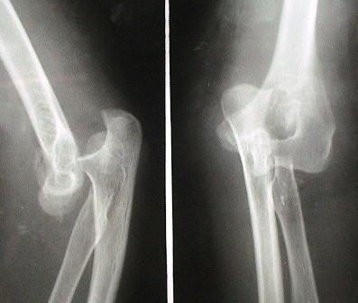 Elbow Dislocation - Mechanism 80-90% posterior or posterolateral Fall on outstretched arm è posterior or