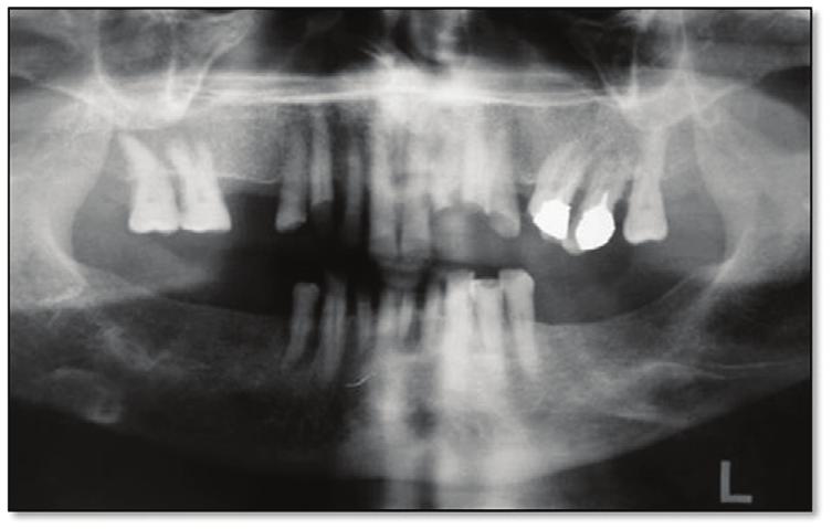 The clinical and radiographic examinations revealed furcation involvement of the maxillary left second molar (grade 3) and periapical pathology involving the mandibular central incisors.