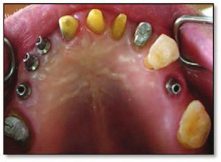 In addition, the crown-root ratio of the mandibular incisors was compromised and greater than a one-to-one relationship, so the mandibular incisors were extracted along with the maxillary right and