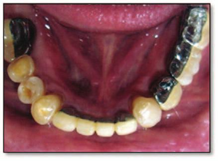 The implant-supported restorations were cemented with a provisional luting agent (Temp-Bond NE; Kerr, Orange, CA, USA) as shown in Figures 8 and 9.
