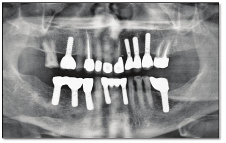 A canine protected occlusion was established to reduce lateral forces on the mandibular implant-supported prosthesis. A hard nightguard was made for the patient to wear at night.