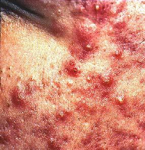 Acne vulgaris: Disorders of the integumentary Common chronic disorder of the sebaceous glands that causes inflammation Pores becomes blocked with dirt, cosmetics, excess oil and or bacteria.