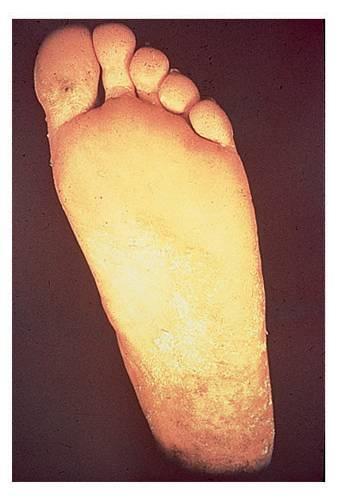 Athlete s foot Caused by a fungal infection and is contagious Symptoms: skin itches,