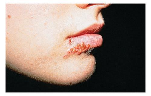 Herpes Disorders of the integumentary Herpes simplex virus Two types of HSV: HSV type 1 - oral HSV type 2 genital Symptoms: blister or multiple blisters on or around affected areas Transmission: oral