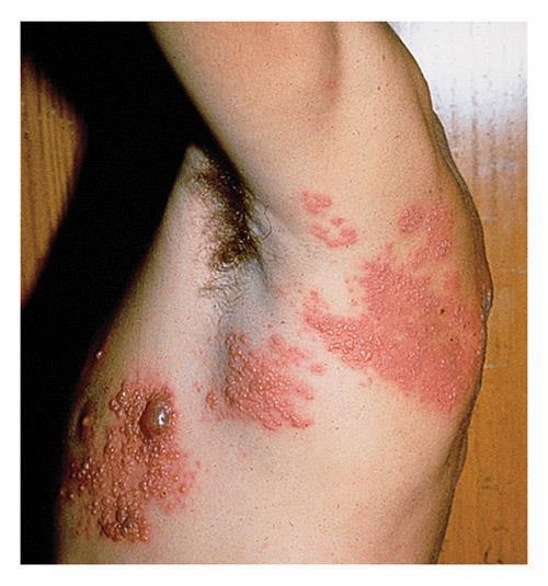 Shingles Disorders of the integumentary Cause: viral nerve infection Commonly seen on the chest or abdomen/causes severe pain A person with shingles can pass the varicellazoster virus to anyone who
