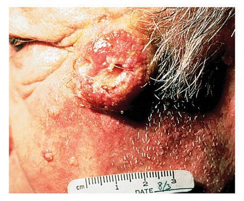 Skin Cancer Squamous cell carcinoma Develops in the thin, flat squamous cells that make up the epidermis.