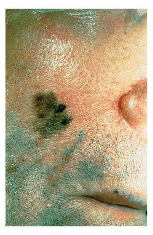 Skin cancer Malignant melanoma Is the most serious type of skin cancer.