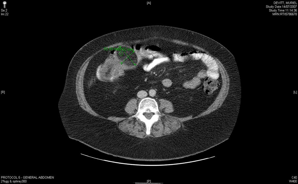 Illustrations Illustration 1 Fig 1a Abdominal CT scan with oral contrast showing well circumscribed fat