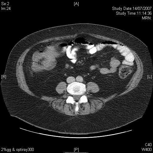 Illustration 2 Fig 1b. Abdominal CT scan with oral contrast showing well circumscribed 4 x 5.