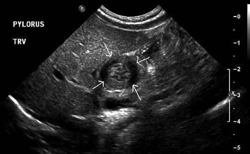 112 SECTION 1 ABDOMINAL SONOGRAPHY REVIEW SONOGRAPHIC FINDINGS OF ACUTE APPENDICITIS 1. Noncompressible, blind-ended tube that measures more than 6 mm in diameter from outer wall to outer wall 2.