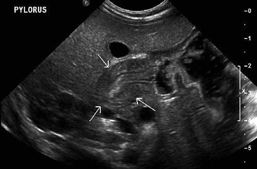 Periappendiceal fluid collection Hypertrophic Pyloric Stenosis The pylorus is the distal region of the stomach.