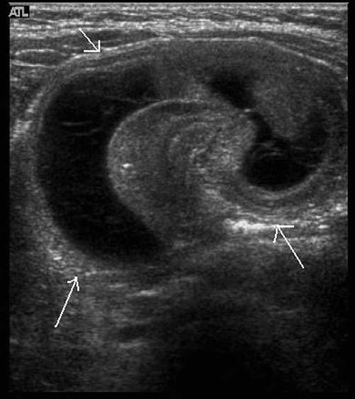 The sonographic diagnosis of malrotation is confirmed by identifying the relationship of the SMA with the superior mesenteric vein (SMV). The SMA is typically located to the left of the SMV.