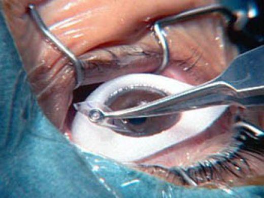 Using Lasers in Surgery Lasers are being increasingly used in laser eye surgery: What are