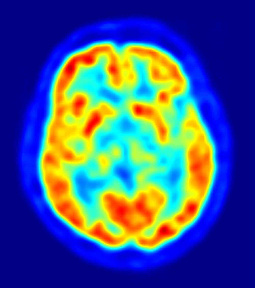 PET (POSITRON EMISSION TOMOGRAPHY) SCAN A VISUAL DISPLAY OF BRAIN ACTIVITY THAT DETECTS WHERE A RADIOACTIVE FORM OF GLUCOSE GOES WHILE THE BRAIN PERFORMS A GIVEN TASK.