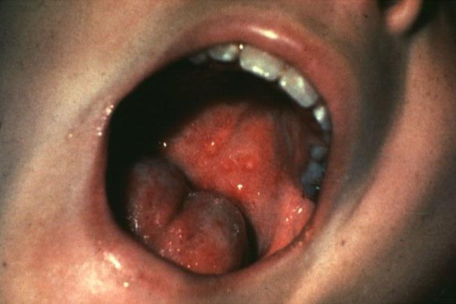 4. ORAL ULCERS: