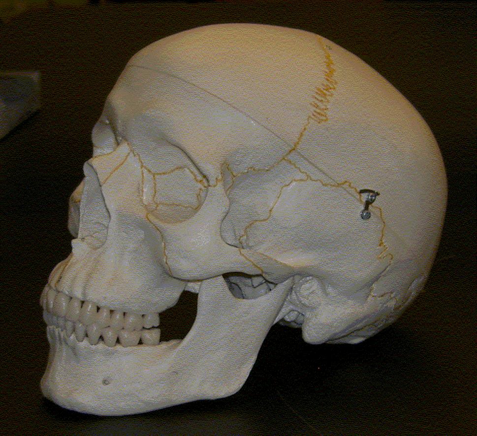 Select your answers for the skull from this list only frontal bone maxilla occipital bone parietal bone temporal bone zygoma coronal suture lambdoidal suture sagittal suture squamosal