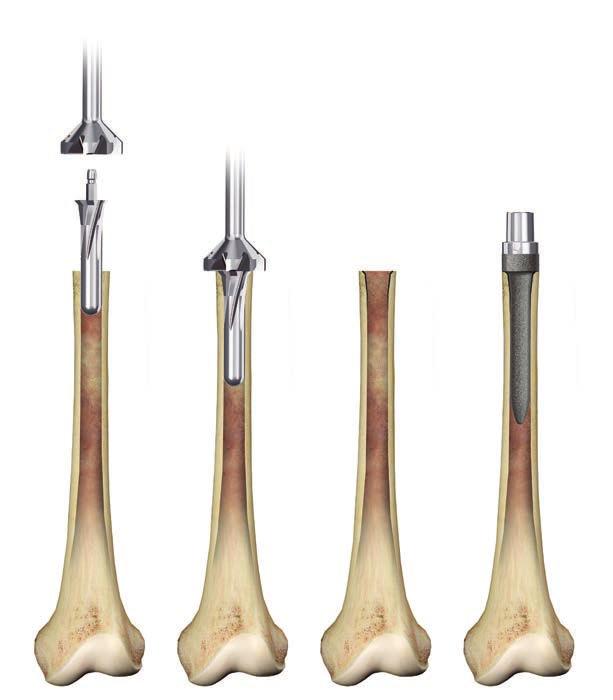 PROXIMAL FEMUR REPLACEMENT Calcar Planer Finish Preparation Using the Calcar Planer/Bevel Reamer Once intramedullary reaming is completed, prepare the osteotomy surface to help assure the stem