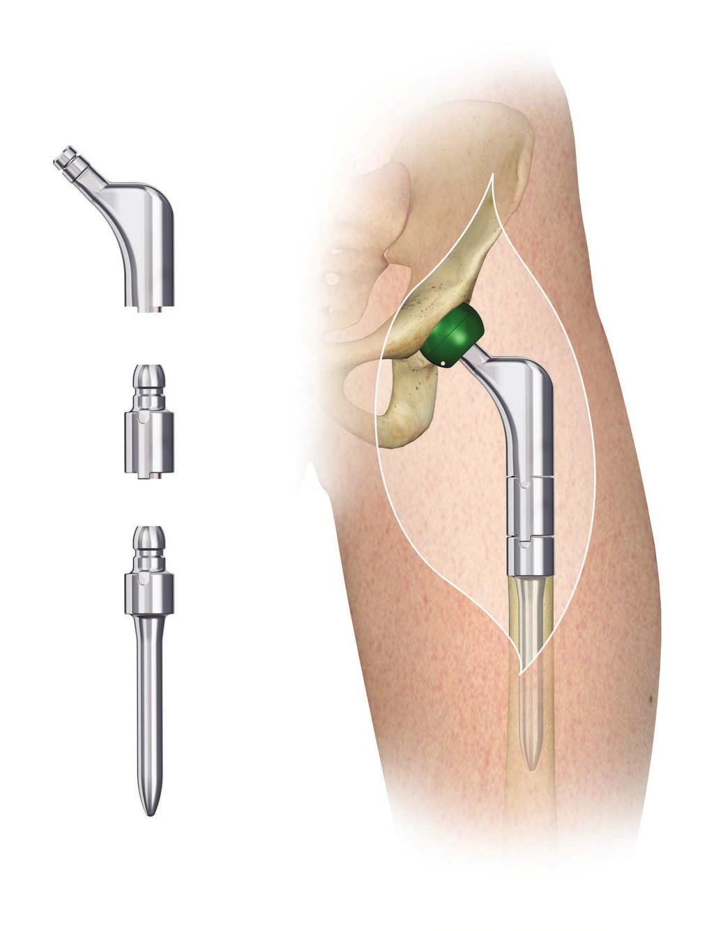 PROXIMAL FEMUR REPLACEMENT Alignment Mark If the soft tissues are tight, the leg length is slightly long and the implant s offset is excessive, evaluate the use of a shorter femoral head trial.