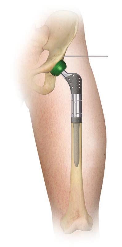 PROXIMAL FEMUR REPLACEMENT Steinmann Pin Reconstruction Measured Distance Perform a final trial reduction with the implant to fine tune soft tissue balancing.