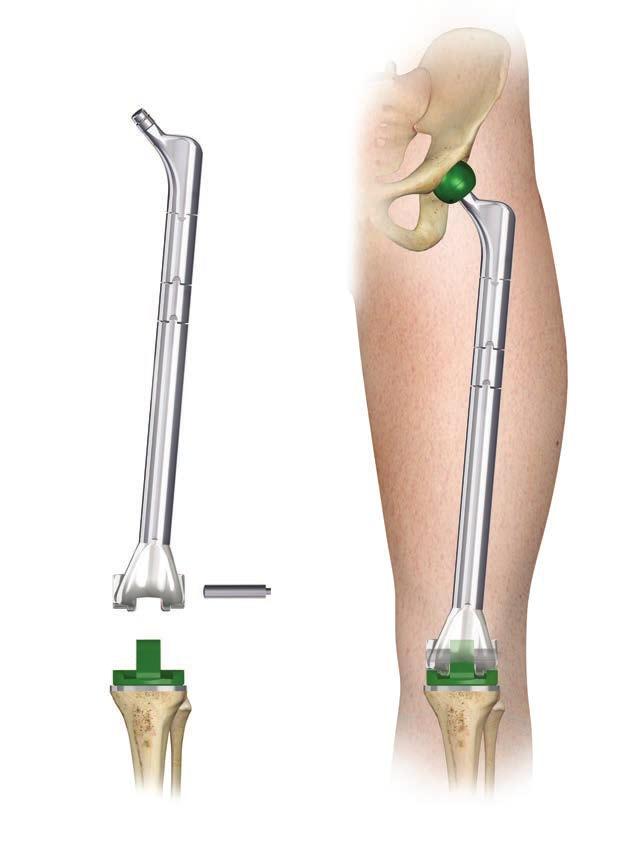 TOTAL FEMUR REPLACEMENT Perform trial reduction after assembling the femoral trial and tibial trial components (Figure 2.5). The trial hinge pin may be inserted either medially or laterally.