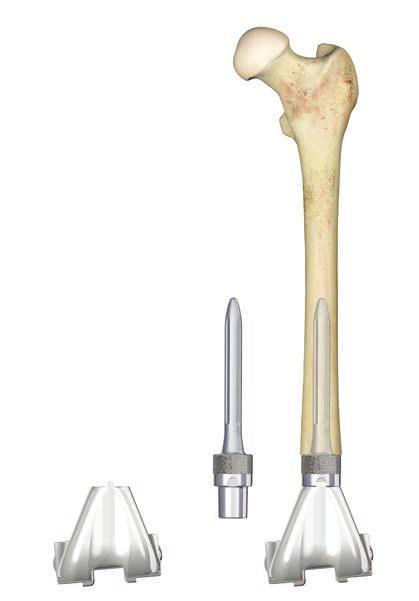 DISTAL FEMUR REPLACEMENT WITH LPS STEM Exposure Use a surgical approach that best achieves the exposure needed for extensive removal of bone in the distal femur and proximal tibia areas.