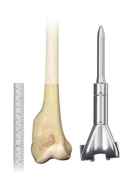 DISTAL FEMUR REPLACEMENT WITH LPS STEM If the distal femur is available in one piece, an alternate method is to measure the resected bone from the osteotomy to the end of the condyles.