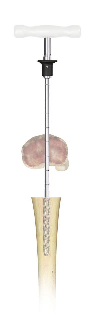 DISTAL FEMUR REPLACEMENT WITH METAPHYSEAL SLEEVE Femur Preparation - with Metaphyseal Sleeve Make the appropriate distal resection as required.