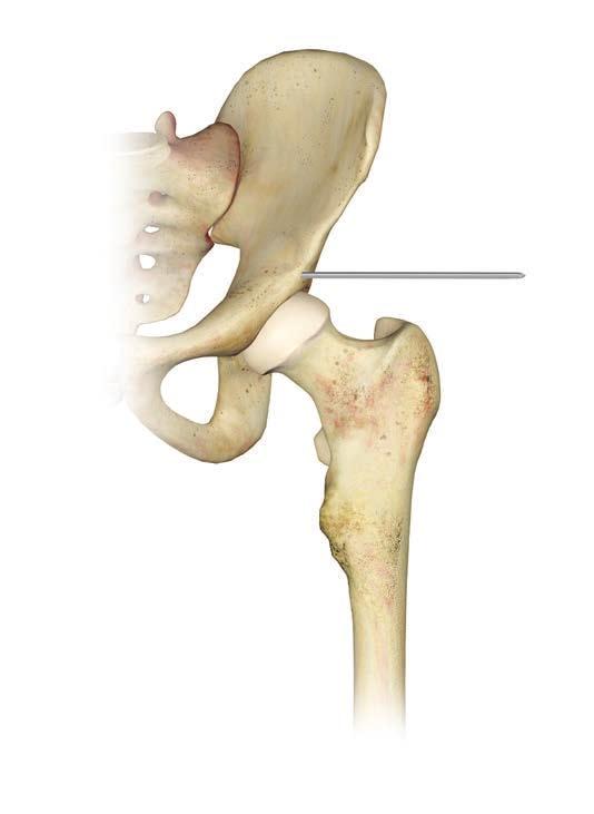PROXIMAL FEMUR REPLACEMENT Exposure and Intra-operative Planning Perform the surgical approach so that every attempt is made to preserve as much of the abductor mechanism and iliotibial band as