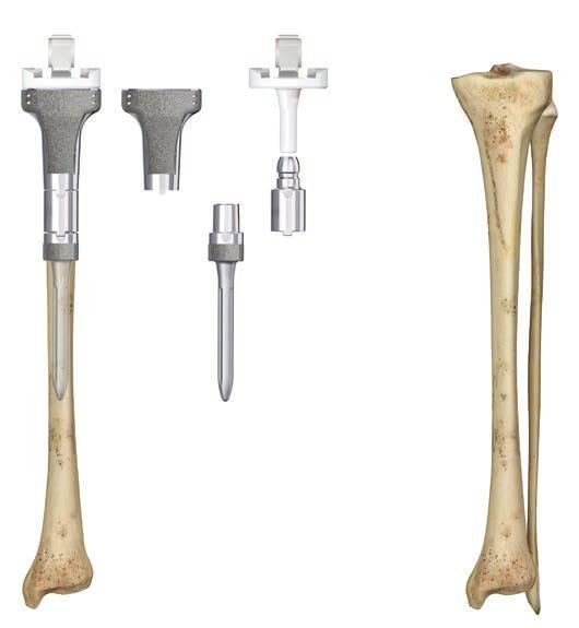 PROXIMAL TIBIA REPLACEMENT Exposure and Intra-operative Planning Use a surgical approach that best achieves the exposure needed for extensive bone removal in the proximal tibia and distal femur.