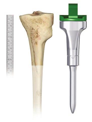 PROXIMAL TIBIA REPLACEMENT Trial Reduction Following the tibial preparation for the stem extension, perform a trial reduction.