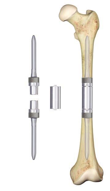 MID-SHAFT FEMUR REPLACEMENT The system is modular and is comprised of two medullary stems in the proximal and distal femur and a one-piece intercalary segmental component.