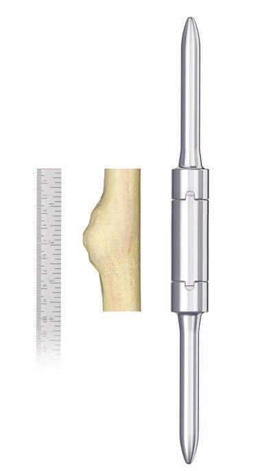 MID-SHAFT FEMUR REPLACEMENT For a cemented stem extension: - Begin reaming with a calcar planer/bevel reamer with a pilot that is at least 1 mm less than the final IM reamer used.