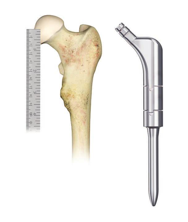 In non-oncological cases, consider leaving a sleeve of bone with the soft tissue deltoid attachments, which can be reattached with cables through the lateral aspect of the proximal body at the end of