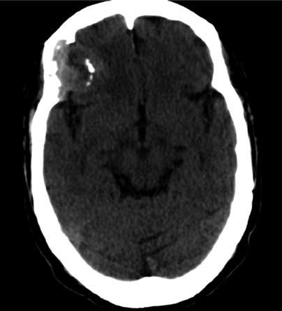 82 Intracranial epidermoid cyst with hemorrhage seen at the right anterior cranial fossa containing old blood and necrotic debris.