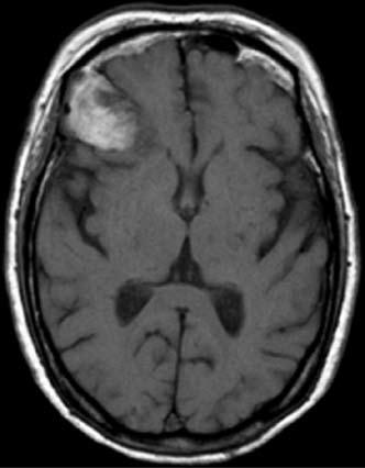 Intracranial epidermoid cyst with hemorrhage 83 2a 2b 2c 2d Figure 2. a. Coronal fast spin echo T2-weighted MR imaging (TR/ TE: 4200/99) show a heterogeneously mixed hyperintense and hypointense mass.