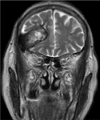 Axial fast spin-echo gadolinium-enhanced T-weighted MR imaging exhibits curvilinear contrast enhancement at medial wall of the mass. d.