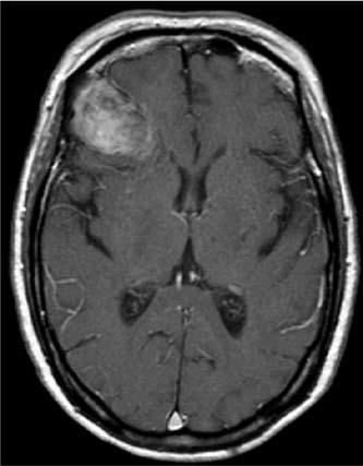 Intracranial cysts: radiologic-pathologic correlation and imaging approach. Radiology 2006; 239: 650-664 2. Hsieh CH, Huang KM, Kao MC, Peng S, Wang CC. Hemorrhage in intracranial epidermoid cyst.