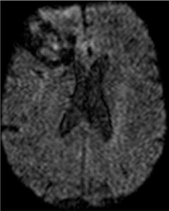 Chen CY, Wong JS, Hsieh SC, Chu JS, Chan WP. Intracranial epidermoid cyst with hemorrhage: MR imaging findings. AJNR Am J Neuroradiol 2006; 27: 427-429 5.